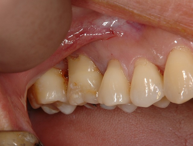 歯周病の骨再生療法-1
