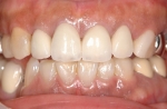 50歳代　女性患者さん　前歯の治療で来院-3