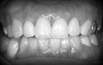 50歳代　女性患者さん　前歯の治療で来院-4