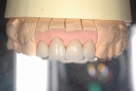 50歳代　女性患者さん　前歯の治療で来院-2
