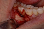 ここまで出来る歯周治療-2