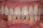 前歯部　不適冠と歯周病により歯が開いてきた-3