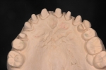 前歯部　不適冠と歯周病により歯が開いてきた-2