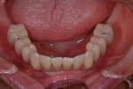 無歯顎患者さんへの近年の治療（オールオン４)-7