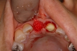 前歯がぐらつき歯肉が腫れる-3
