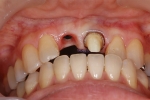 前歯がぐらつき歯肉が腫れる-4
