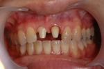前歯がぐらつき歯肉が腫れる-6