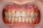 前歯がぐらつき歯肉が腫れる-7