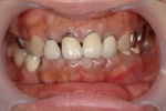 50歳代　女性患者さん　前歯の治療で来院-1