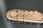 奥歯の審美治療-3