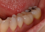奥歯の審美治療-4