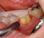 奥歯の審美治療-2