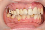 以前治療した歯の 歯肉の退縮が気になる -1