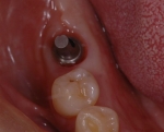 歯周病で失った歯をインプラントで再現-3