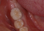歯周病で失った歯をインプラントで再現-5