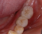 歯周病で失った歯をインプラントで再現-6