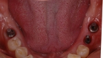 歯周病で失った歯をインプラントで再現-1