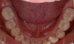 歯周病で失った歯をインプラントで再現-2