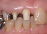 年齢に応じた歯冠処置-2