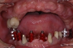歯周病で歯がぐらぐらする-1