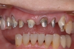 前歯部　不適冠と歯周病により歯が開いてきた-1