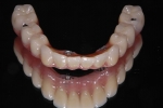無歯顎患者さんへの近年の治療（オールオン４)-3