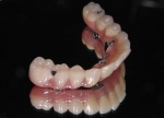 無歯顎患者さんへの近年の治療（オールオン４)-5
