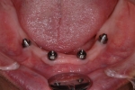 無歯顎患者さんへの近年の治療（オールオン４)-6
