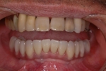 無歯顎患者さんへの近年の治療（オールオン４)-8