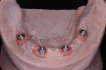 無歯顎患者さんへの近年の治療（オールオン４)-1