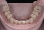 無歯顎患者さんへの近年の治療（オールオン４)-2