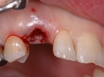 治療した歯の根が腐って来院-2