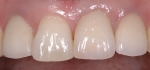 前歯の変色-3