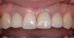 前歯の変色-2