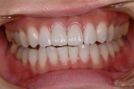 歯並び直して　白く綺麗な歯にしたい-5