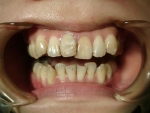歯並び直して　白く綺麗な歯にしたい-1
